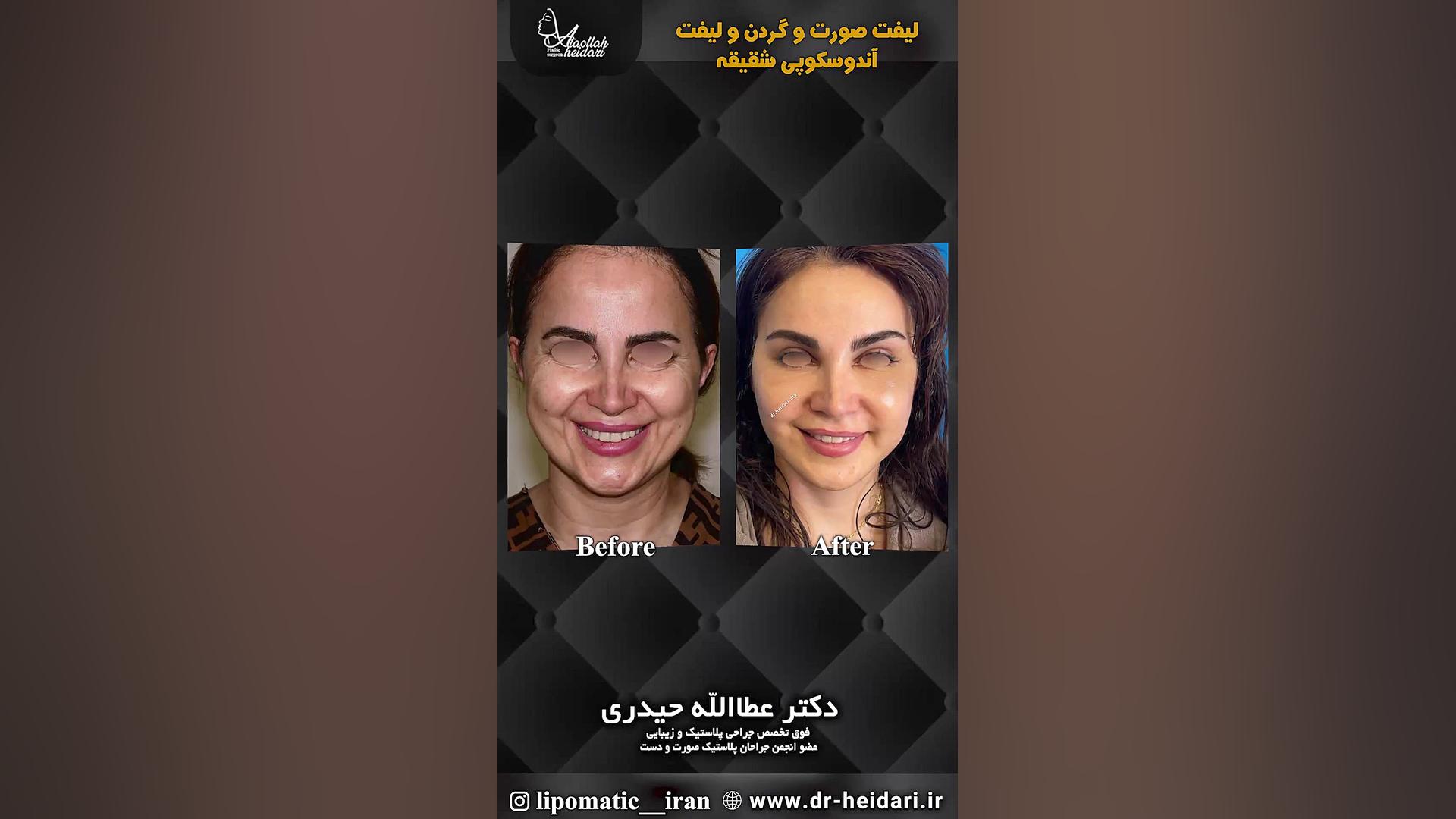 لیفت صورت و گردن و لیفت آندوسکوپی شقیقه پیلینگ