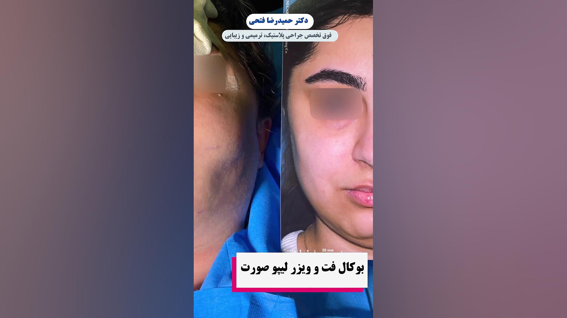 بوکال فت و ویزرلیپو صورت دکتر حمید رضا فتحی فوق تخصص جراحی پلاستیک