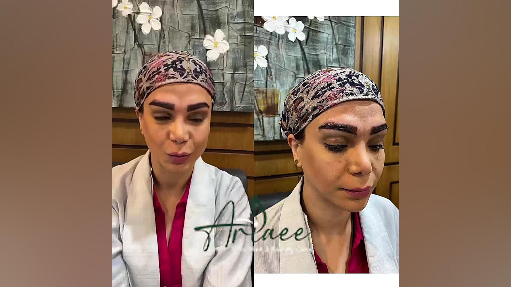 کاشت ابرو بیماری استئوجنز ایمپرفکتا