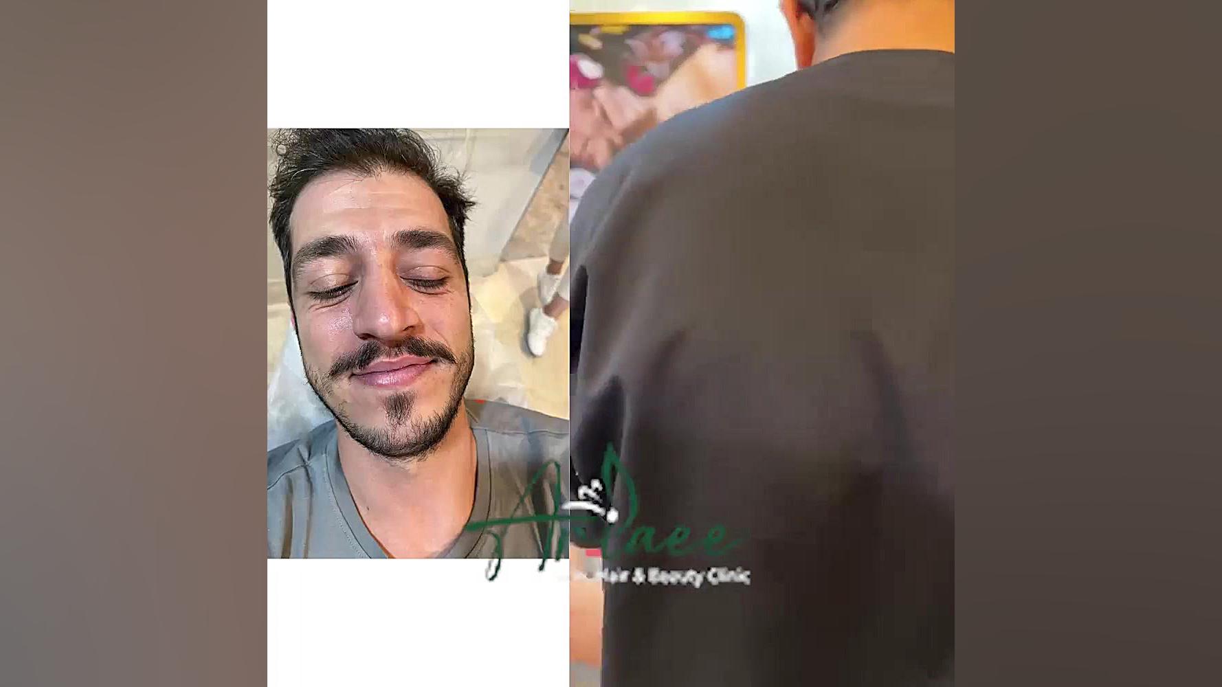 تزریق بوتاکس جراحی بینی