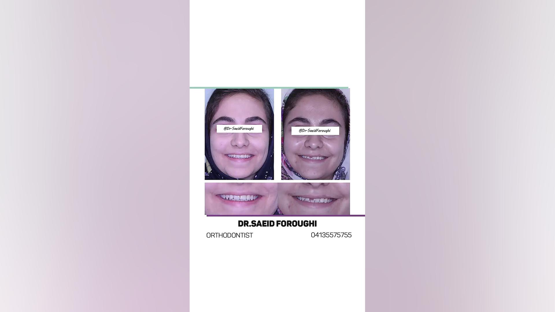 درمان ارتودنسی جهت به قوس آوردن دندان نهفته ثنایای میانی سمت راست فک بالا دکتر سعید فروغی متخصص ارتودنسی