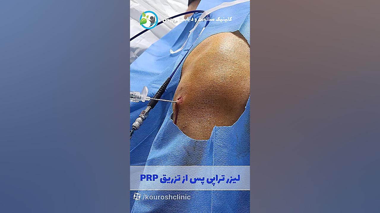 درمان آرتروز زانو به روش PRP و تزریق سلول بنیادی به همراه لیزر تراپی بیماری منیر