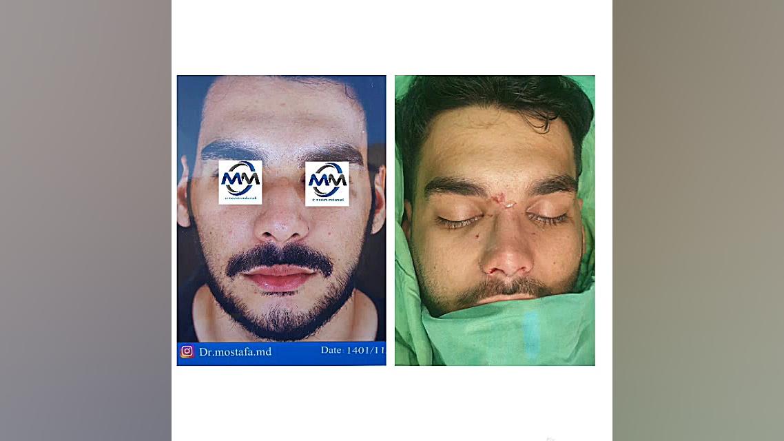 عمل زیبایی بینی دکتر مصطفی محمدی گچساران پلی‌مایالژیا روماتیکا