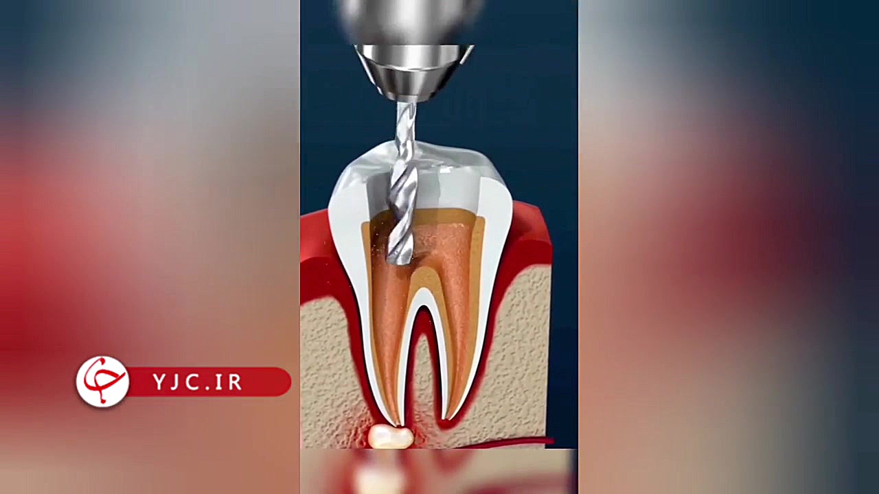 انیمیشنی از چگونگی عصب کشی دندان DLCO