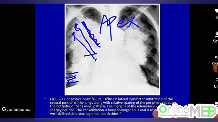 ادم ریوی در CXR کامپوزیت ونیر