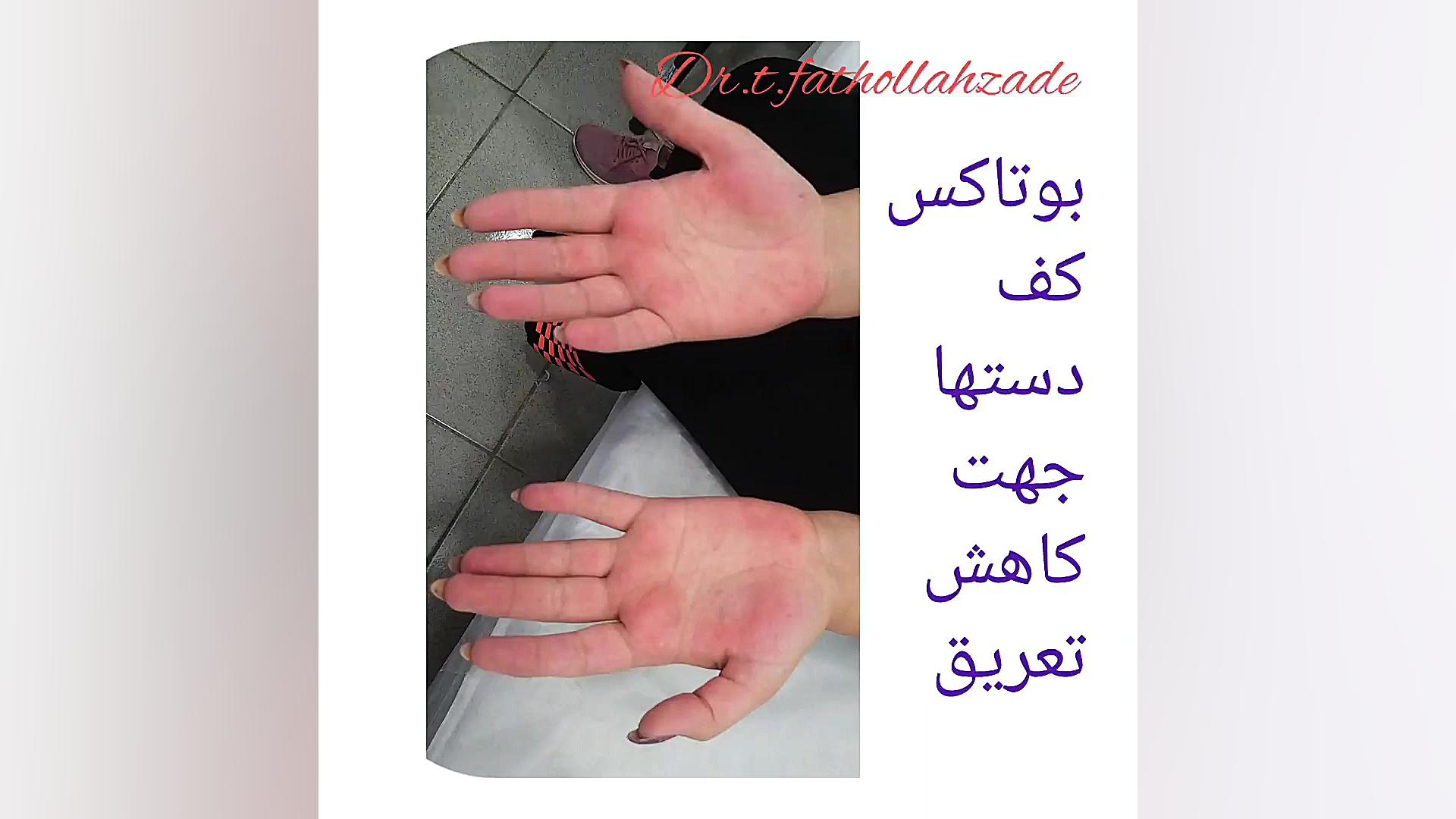 پایان تعریق دستها کاشت ابرو