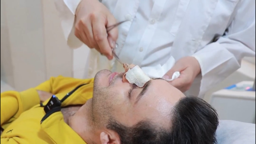 بینی گوشتی مردانه بلافاصله پس از باز شدن چسب دکتر جواد رحمتی