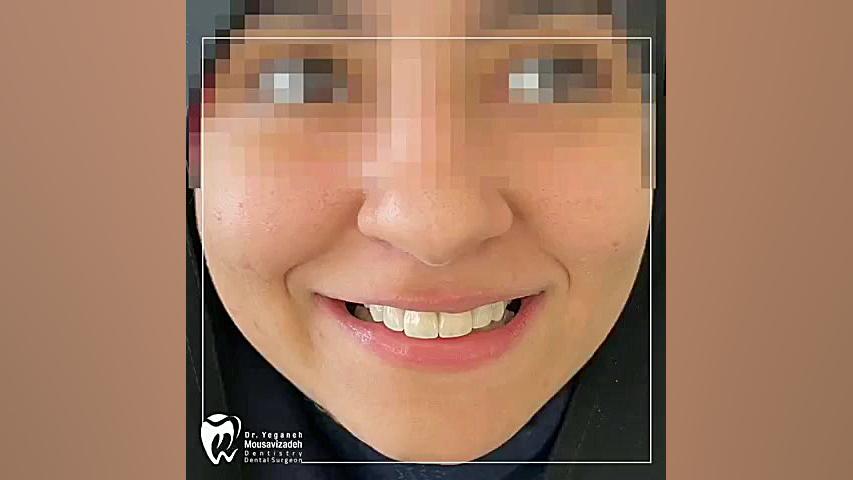نمونه کار اصلاح طرح لبخند عصب‌کشی