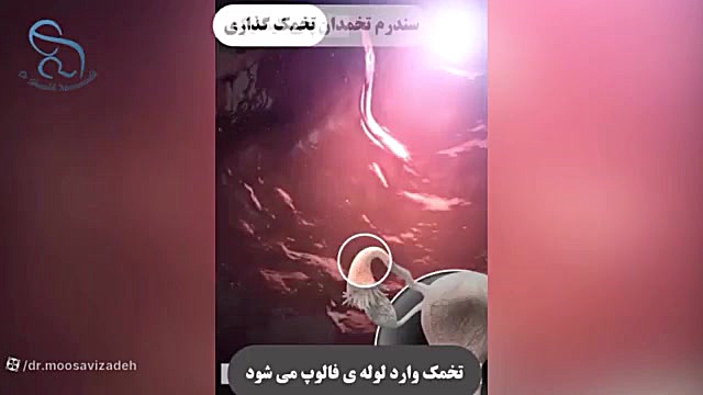 سندرم تخمدان پلی کیستیک ترمیم ونیر
