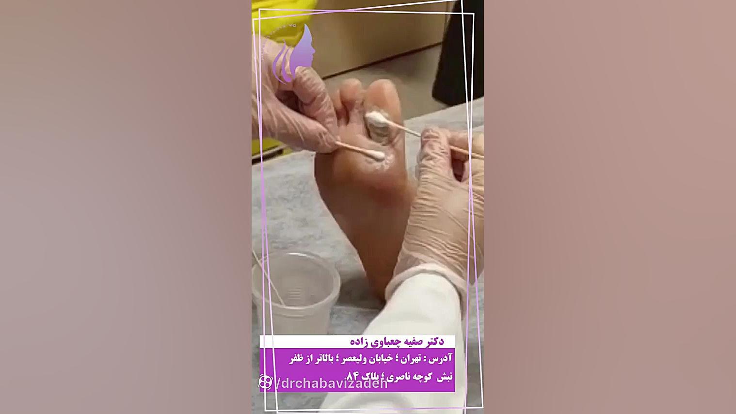 کاشت مو '''بدون تراشیدن موهای سر''' با تراکم بالا دکتر صفیه چعباوی زاده
