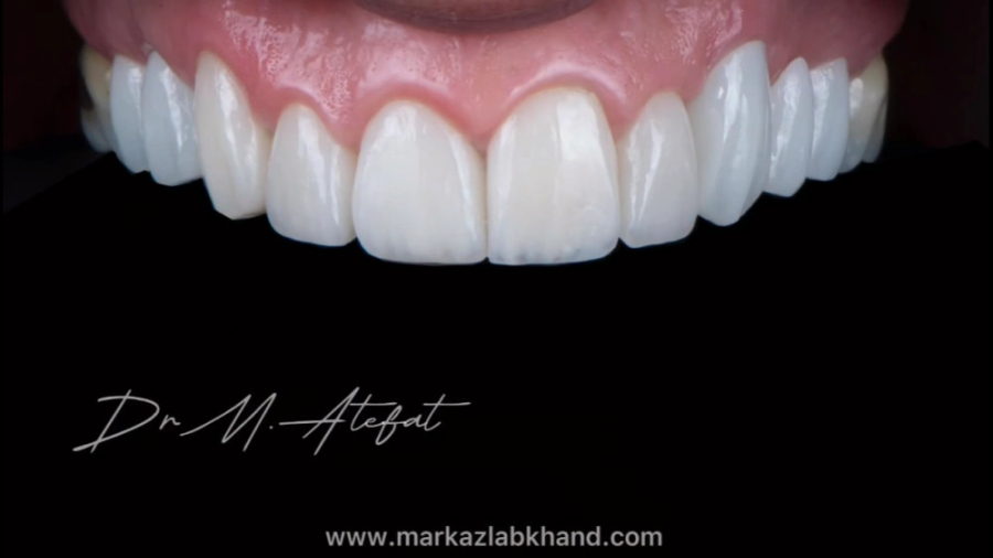 درمان ترکیبی روکش و لمینیت سرامیکی افزایش طول تاج | دکتر محمد عاطفت دکتر محمد عاطفت متخصص ترمیمی و زیبایی اصفهان