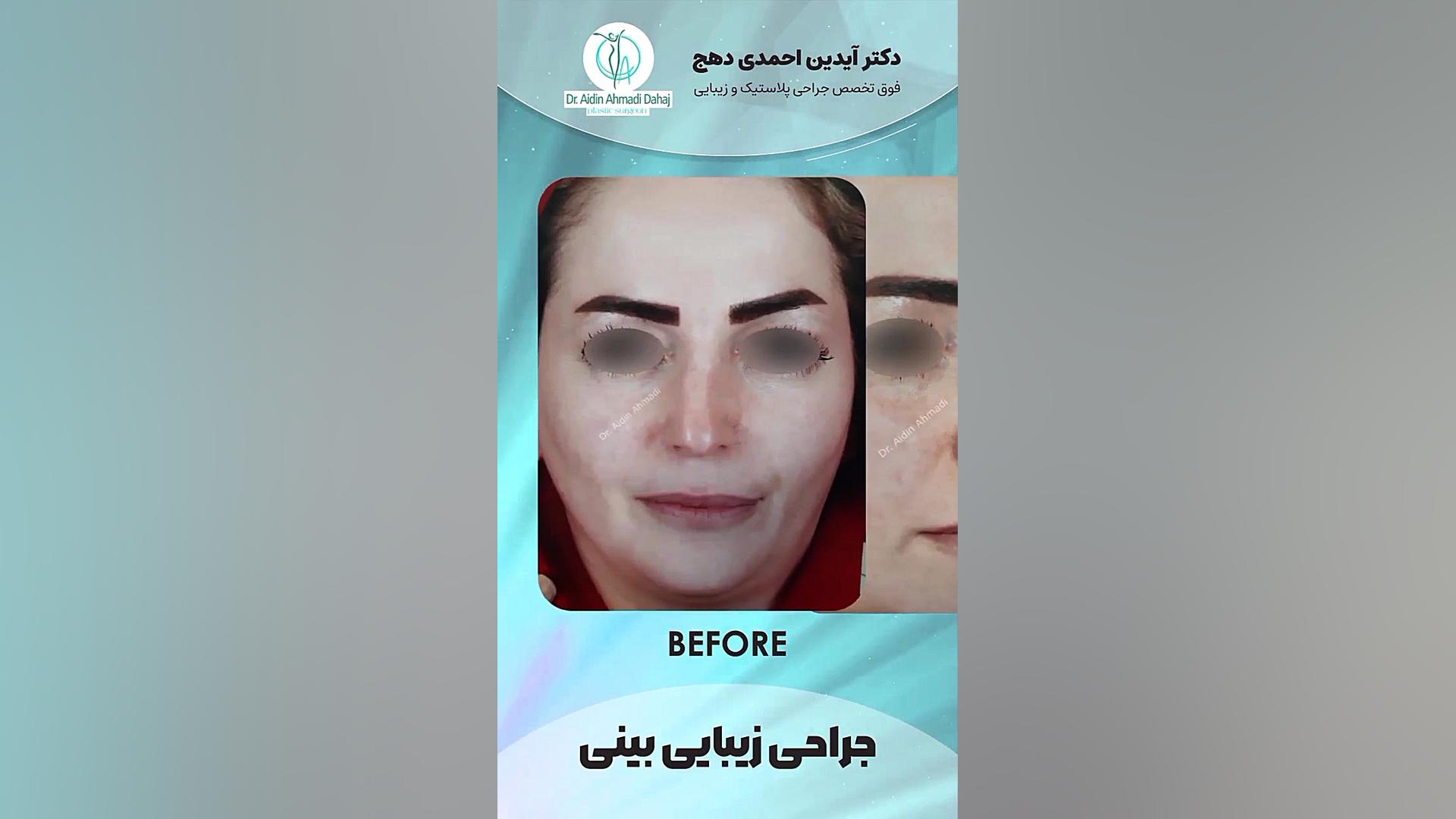 عمل جراحی زیبایی بینی - دکتر احمدی دهج دکتر آیدین احمدی دهج | جراح پلاستیک