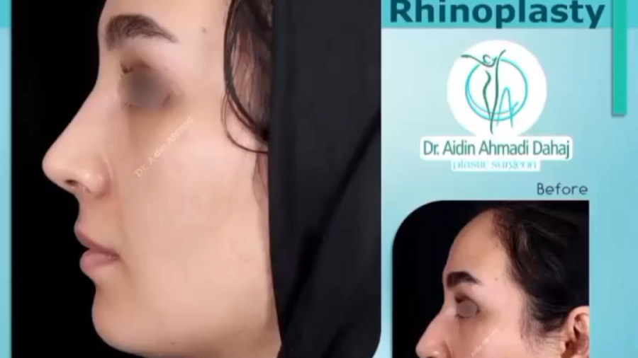 جراحی زیبایی بینی در تهران توسط جراح پلاستیک دکتر آیدین احمدی دهج | جراح پلاستیک