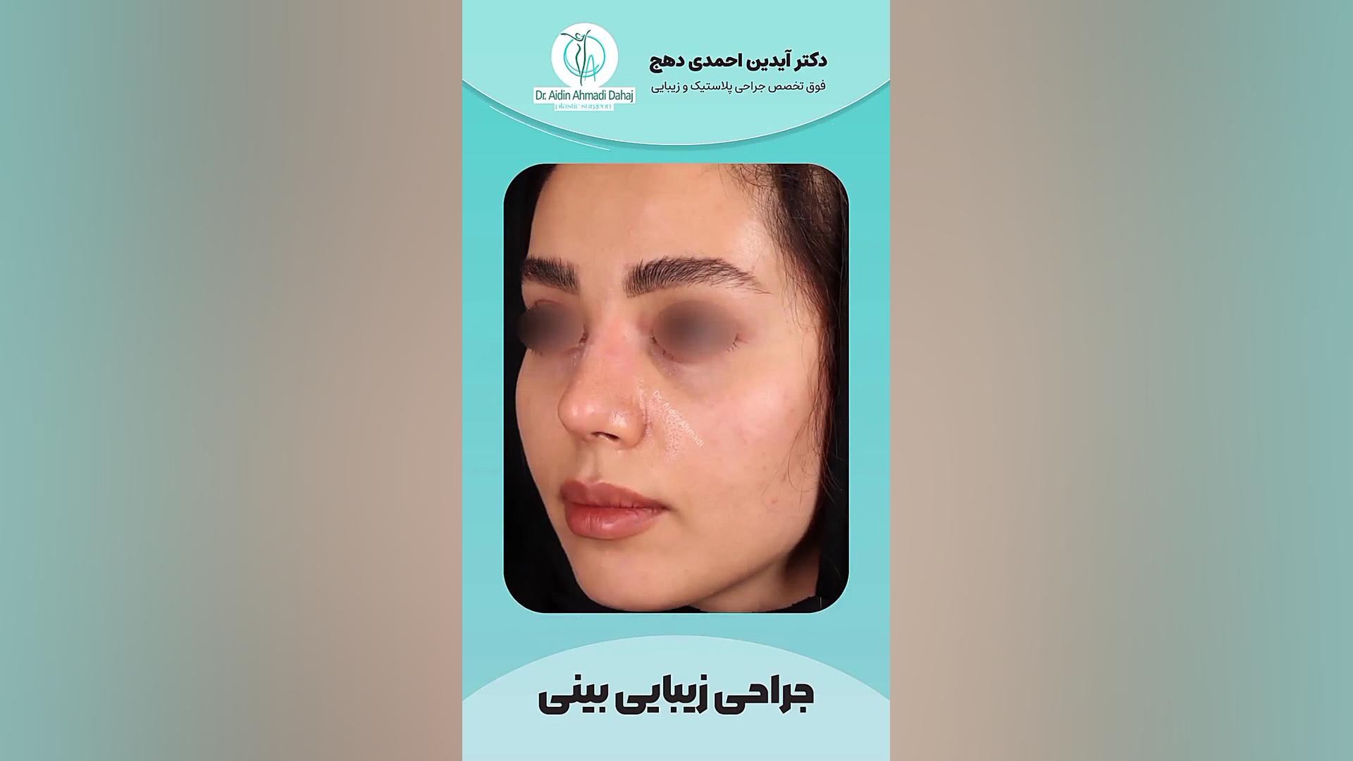 فیلم جراحی زیبایی بینی - دکتر احمدی دهج دکتر آیدین احمدی دهج | جراح پلاستیک