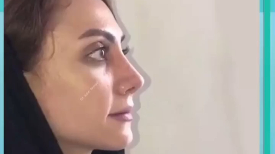 رینوپلاستی توسط دکتر آیدین احمدی دهج دکتر آیدین احمدی دهج | جراح پلاستیک