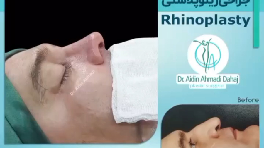 جراحی بینی در آقایان دکتر آیدین احمدی دهج | جراح پلاستیک