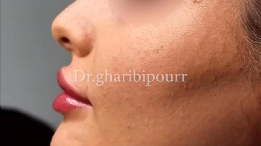 مدلینگ صورت و تزریق ژل لب، خط گونه و چانه لیزر کوانتومی جراحی چشم