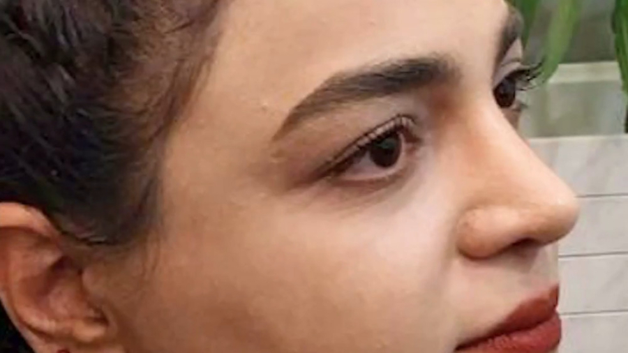 جراحی طبیعی بینی دکتر فاطمه مختاری فر جراح بینی در لرستان