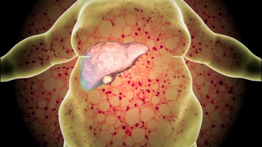 علائم و راه های درمان کبد چرب (2023) رفع افتادگی پلک