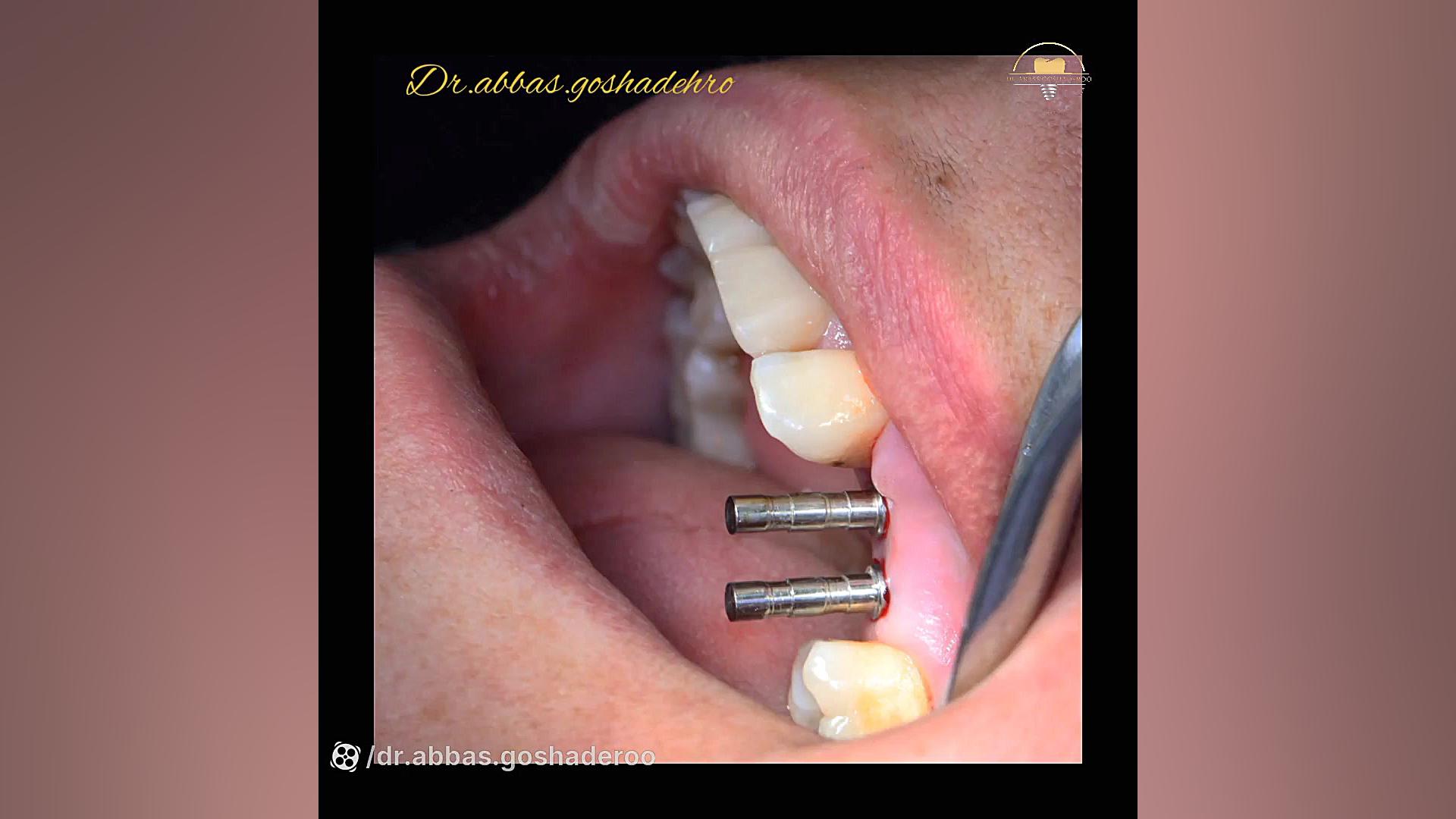 جراحی ایمپلنت به روش پانچ، بدون بخیه دکتر عباس گشاده رو، متخصص جراحی لثه و ایمپلنت