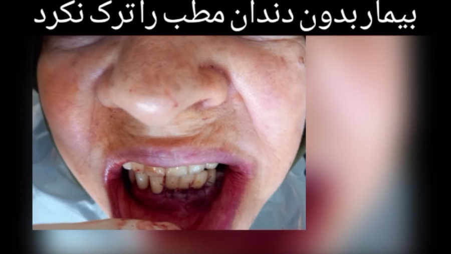فیلم تحویل روکش ایمپلنت در همان روز جراحی زمان28ثانیه