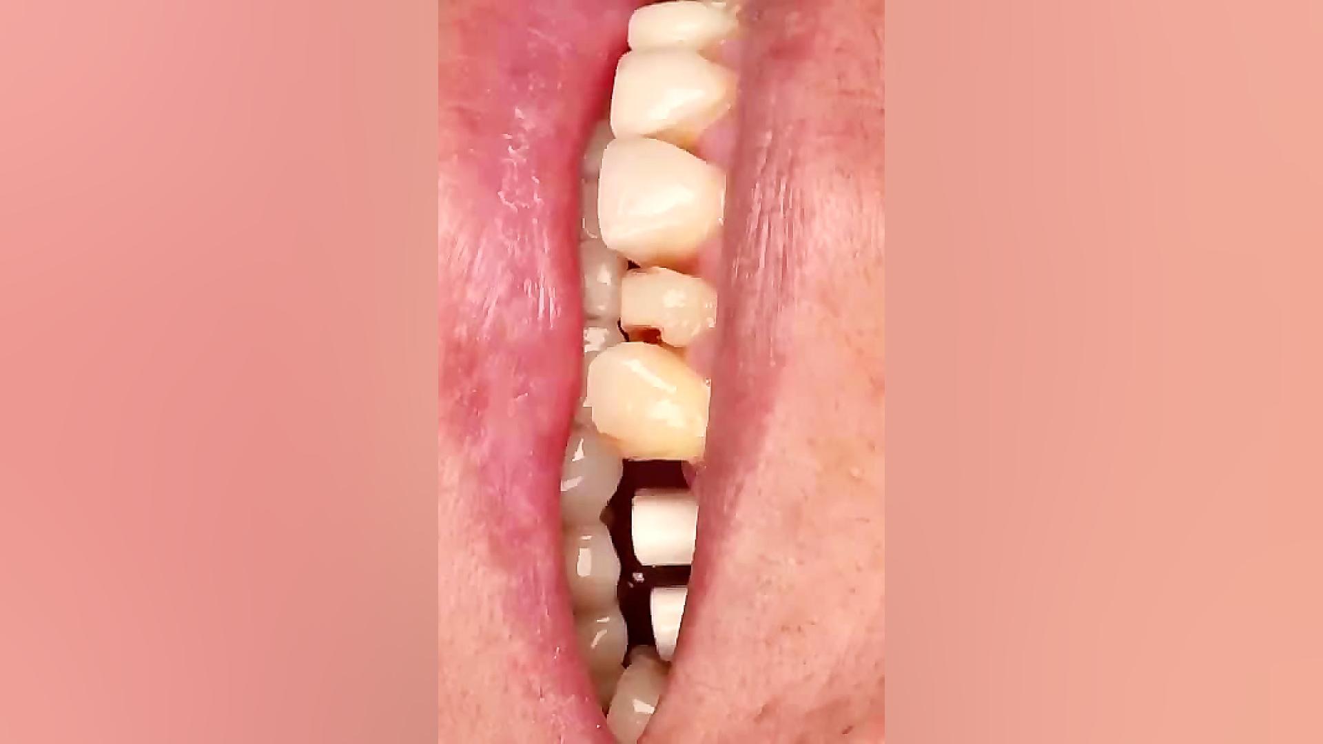 ترمیم و اصلاح خط لبخند قارچ‌شناسی پزشکی