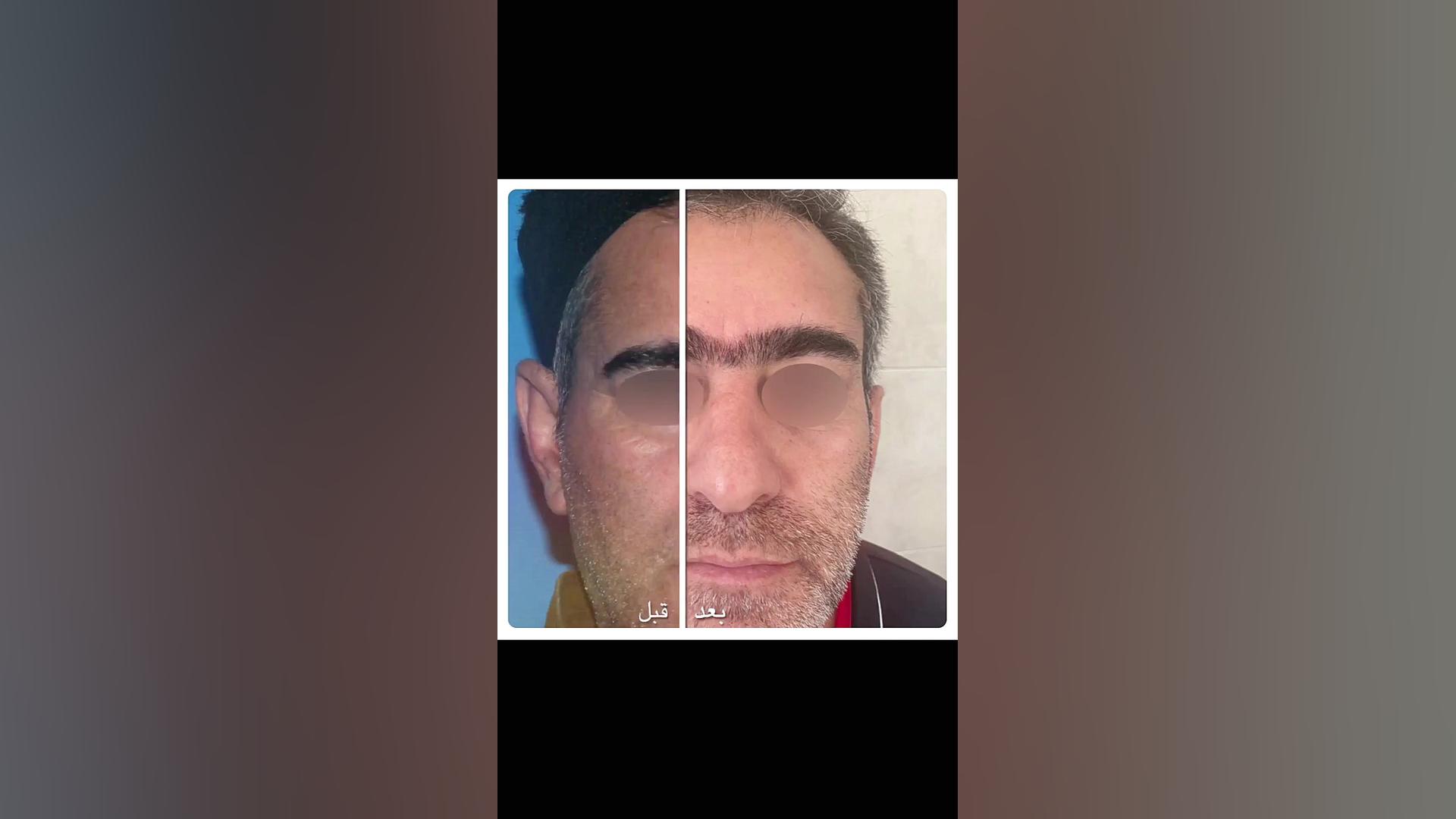 لیفت آندوسکوپی ابرو دکتر جواد رحمتی