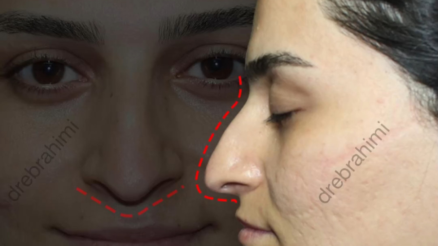 جراحی زیبایی بینی توسط بهترین جراح بینی در تهران دکتر امید ابراهیمی دکتر امید ابراهیمی
