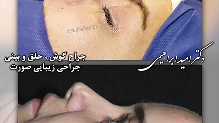 عمل ترمیمی بینی توسط دکتر امید ابراهیمی بهترین جراح ترمیم بینی در تهران دکتر امید ابراهیمی