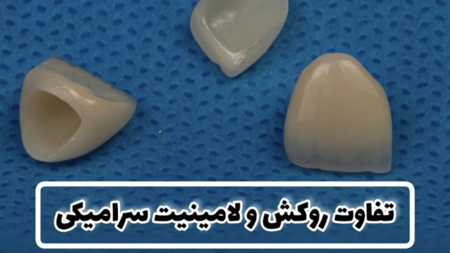 تفاوت روکش و لامینیت سرامیکی دکتر سپیده کاظمی زاده