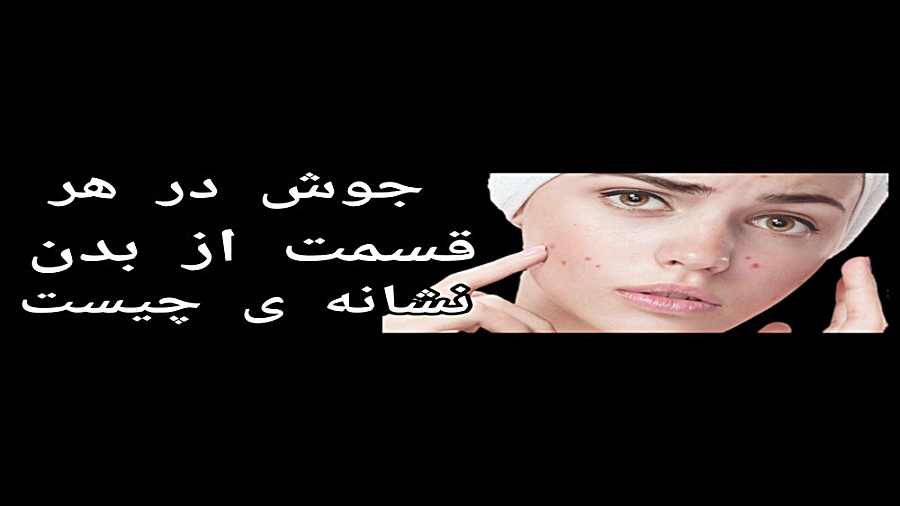 دلیل ایجاد جوش در هر قسمت از بدن اصلاح فرم صورت