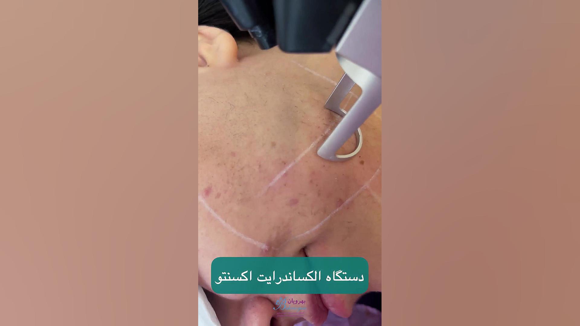 لیزر موهای زائد صورت با دستگاه الکساندرایت اکسنتو بیوسنسور لاکتات خون