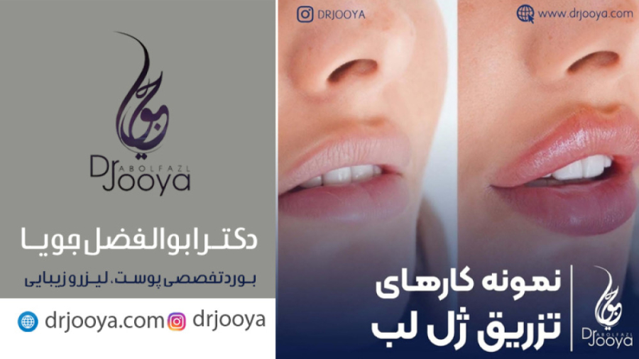 نمونه کارهای تزریق ژل لب | بهترین متخصص پوست، مو، لیزر و زیبایی اصفهان دکتر ابوالفضل جویا