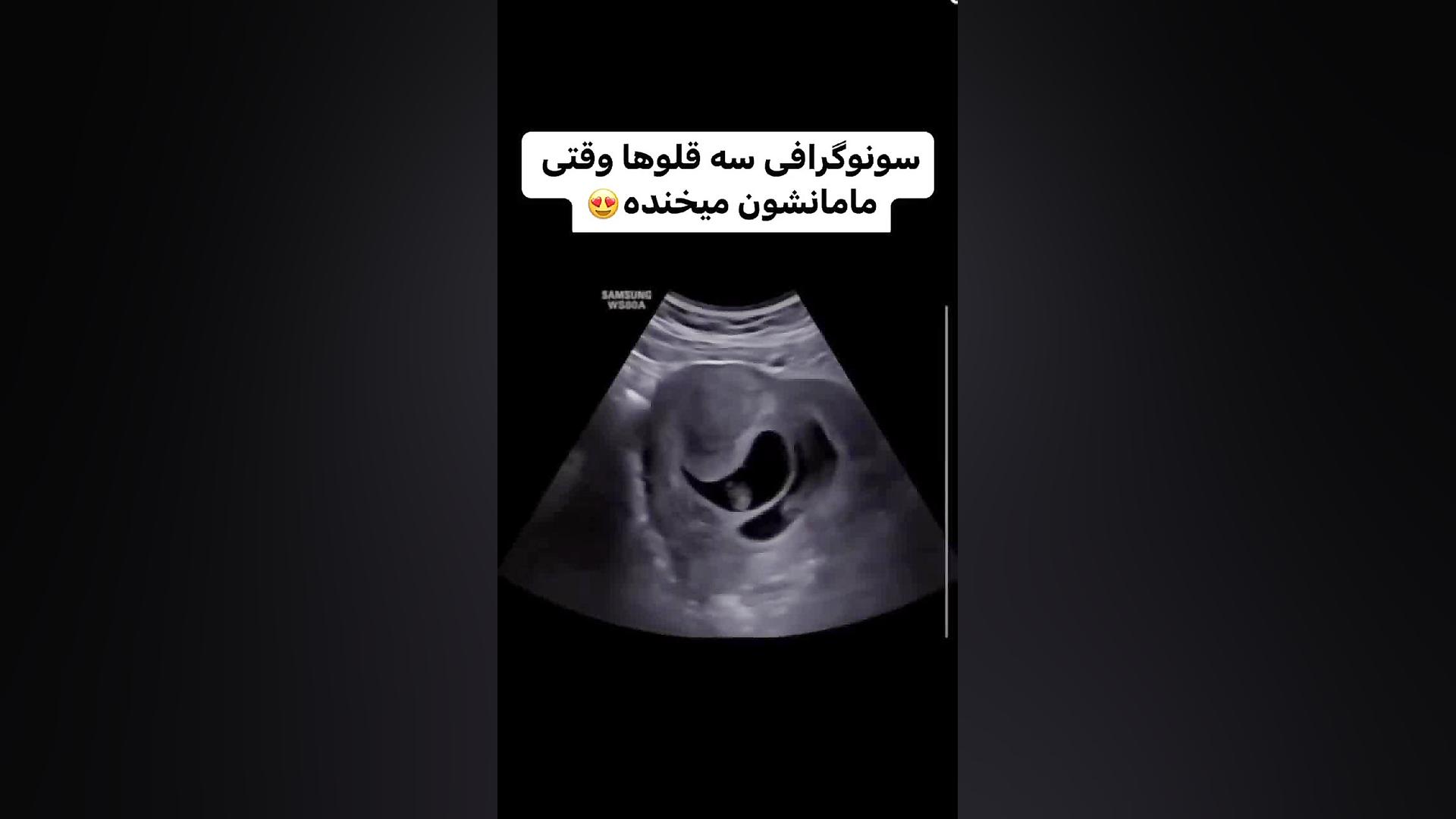 سونوگرافی سه قلوها آهنگ جدید