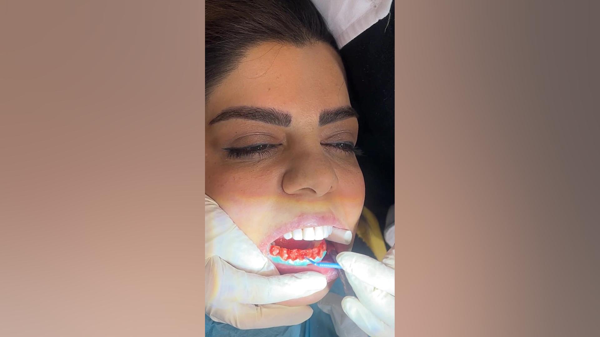 بليچينگ دندان چيست عمل زیبایی