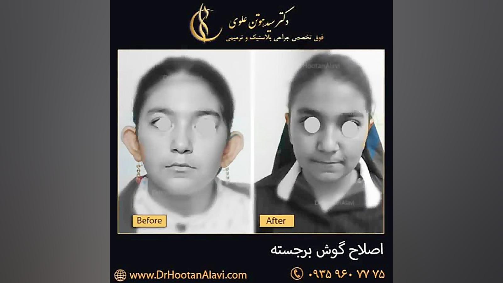 جراحی گوش برجسته پزشکی هیپر باریک