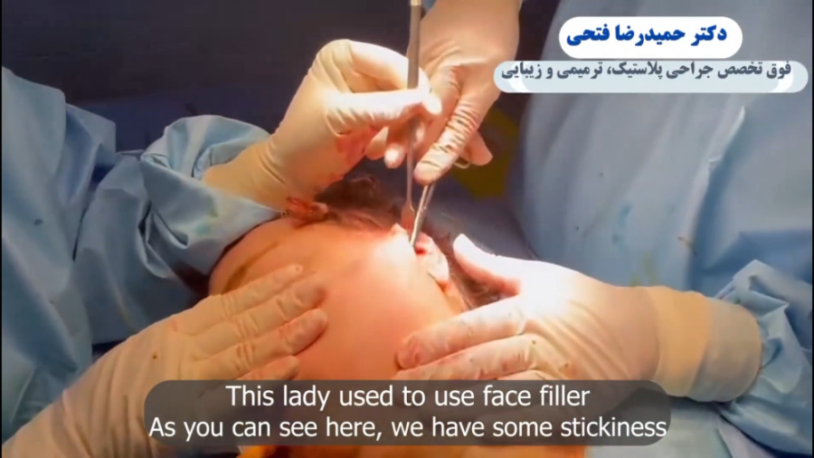 فیلم جراحی فیس لیفت دکتر حمید رضا فتحی فوق تخصص جراحی پلاستیک