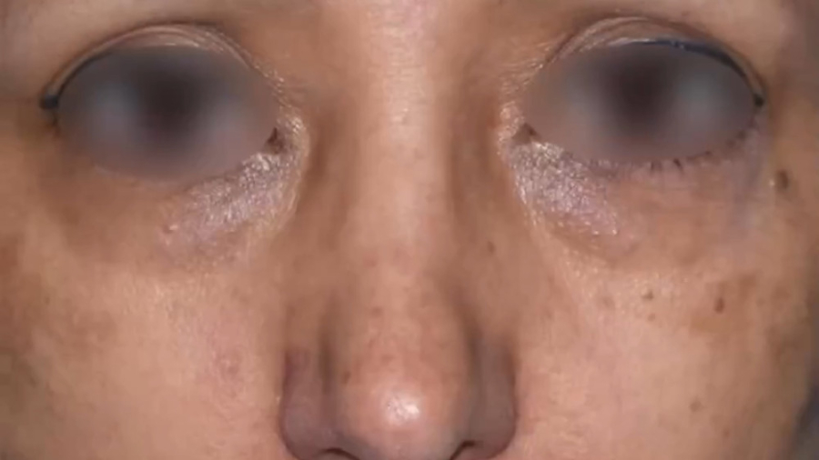 نمونه جراحی لیفت صورت و گردن دکتر فتحی دکتر حمید رضا فتحی فوق تخصص جراحی پلاستیک