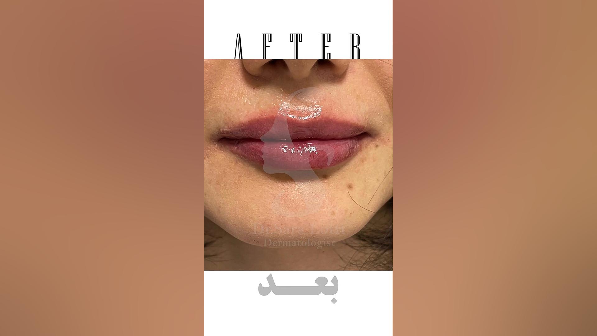 تزریق فیلر لب دکتر سار ا لطفی