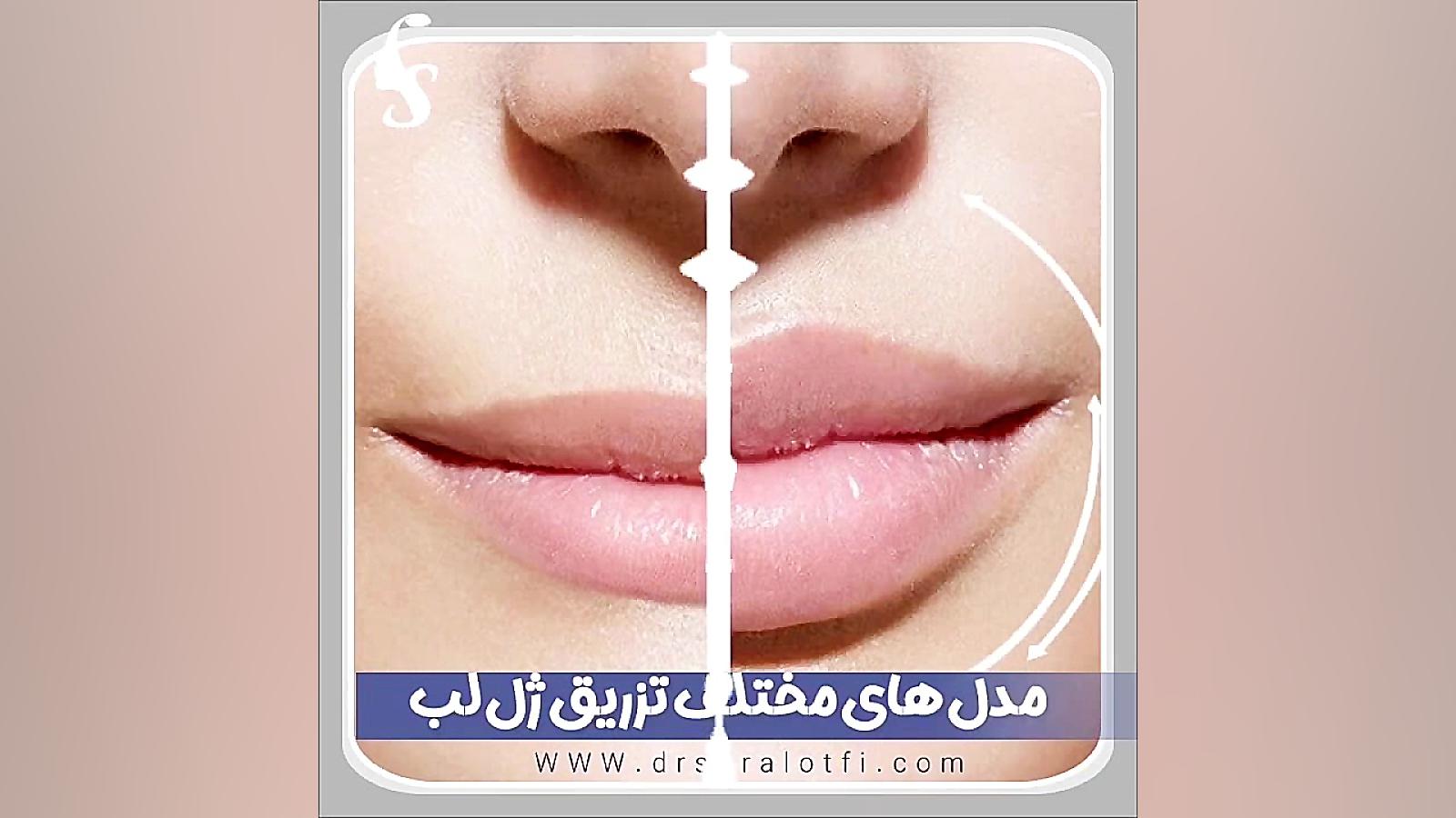 مدل های مختلف تزریق ژل لب دکتر سار ا لطفی