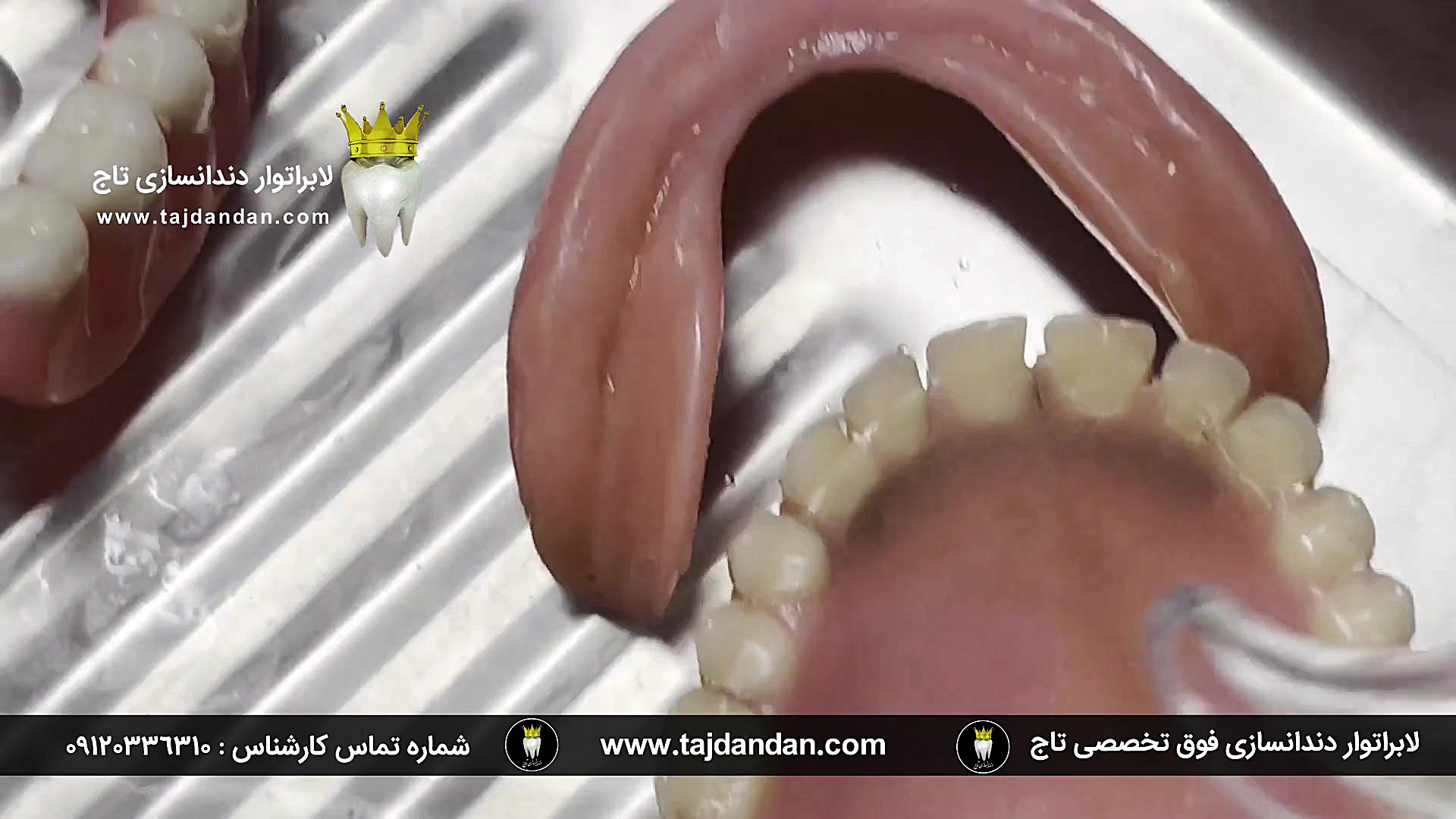 رضایت بیمار با تحلیل لثه شدید از ساخت پروتز دندان ایووبیس سویئسی ترمیم ونیر