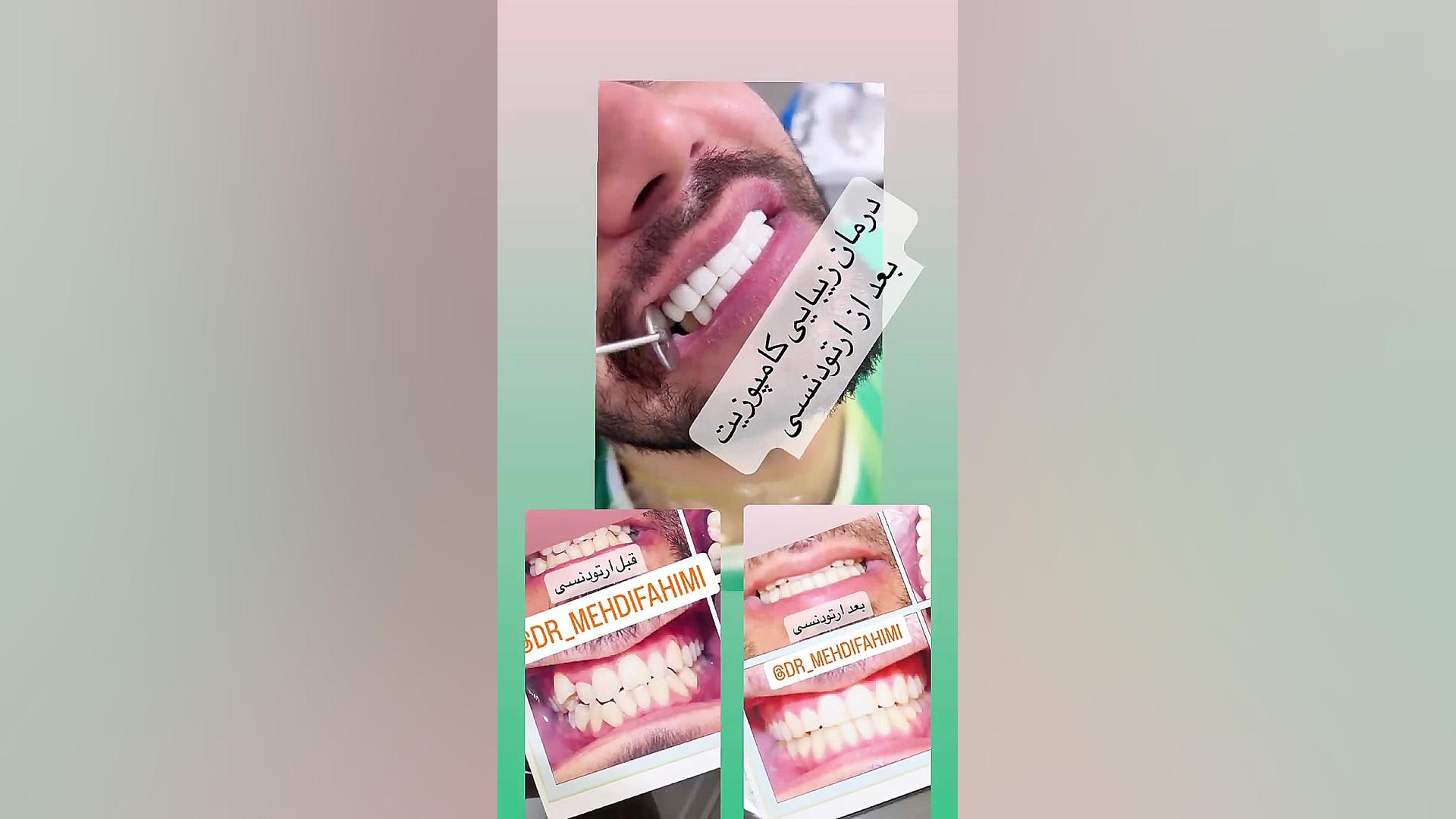 ارتودنسی برای کامپوزیت دكتر مهدي فهيمي هنزائي