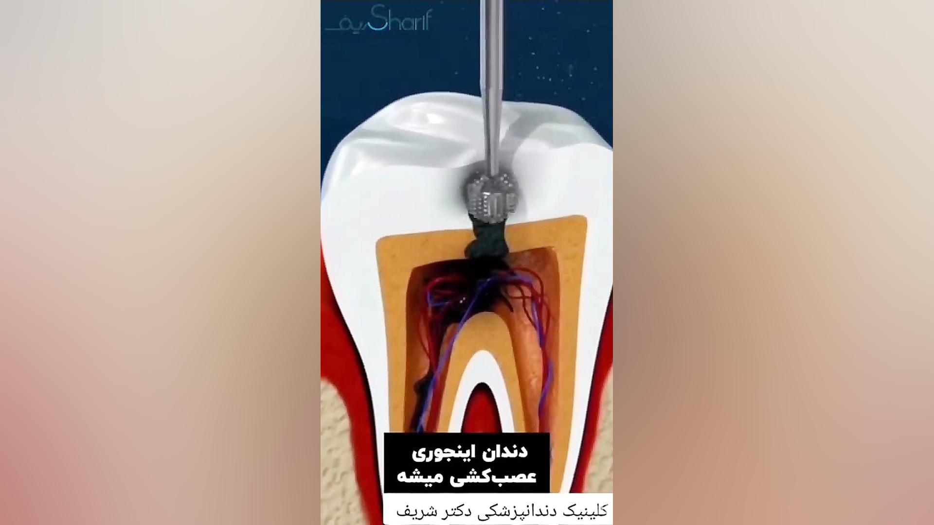 عصب کشی دندان بیماری شوگرن