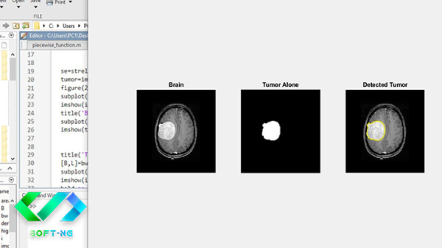 تشخیص تومور مغزی در تصویر MRI  مغز در نرم افزار MATLAB درمان سلولیت