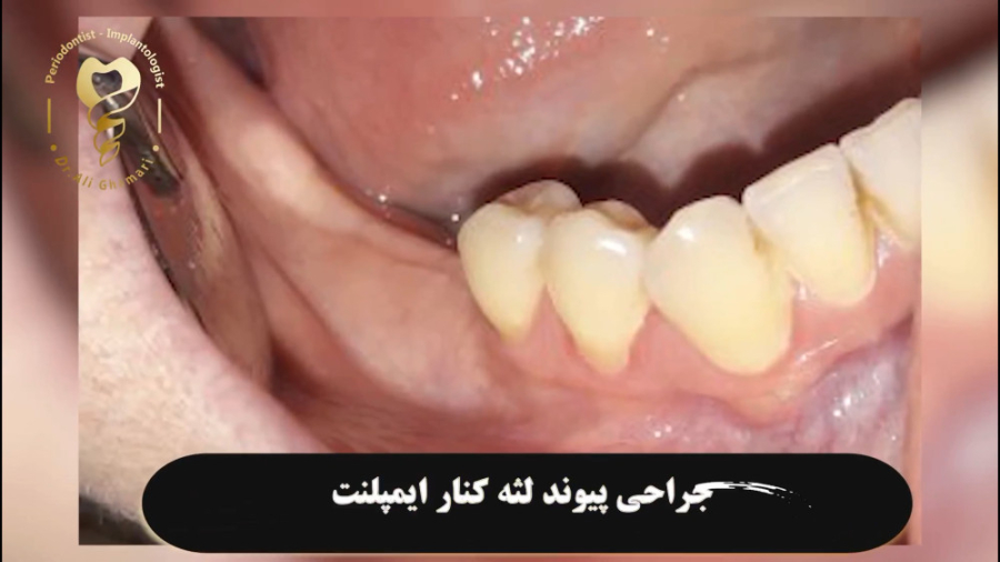 جراحی پیوند لثه کنار ایمپلنت دکتر علی قمری - متخصص جراحی لثه و ایمپلنت