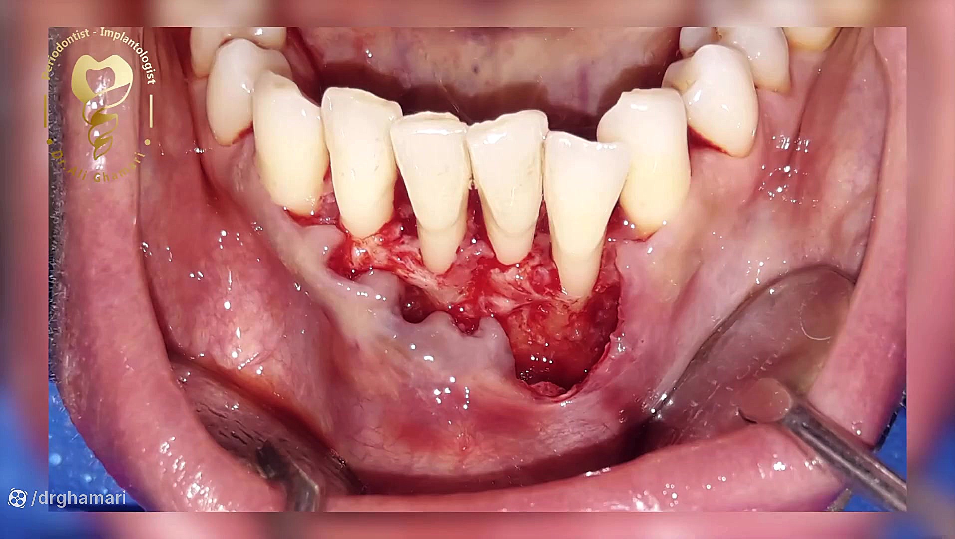 پیوند لثه دندان های جلو فک پایین دکتر علی قمری - متخصص جراحی لثه و ایمپلنت