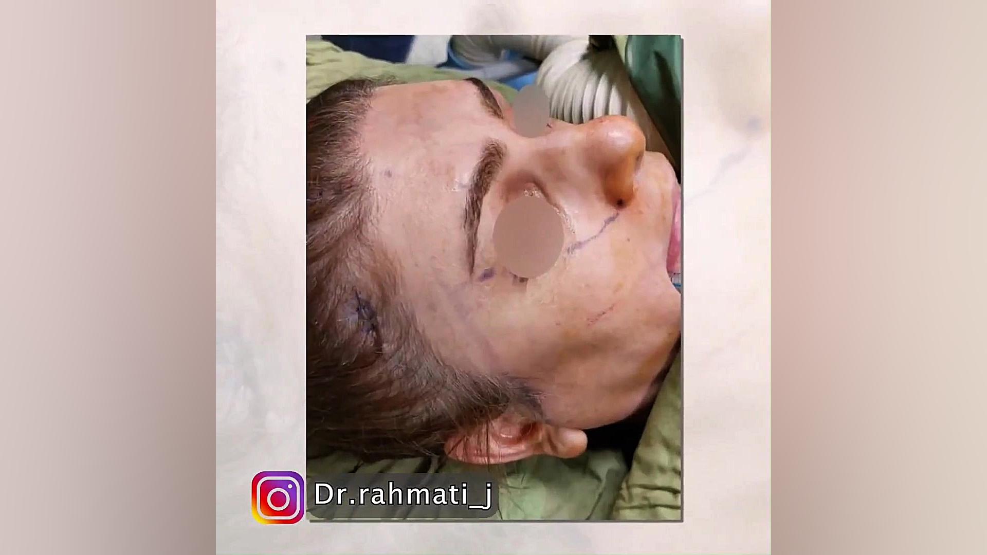 ليفت آندوسكوپيك ابرو دکتر جواد رحمتی