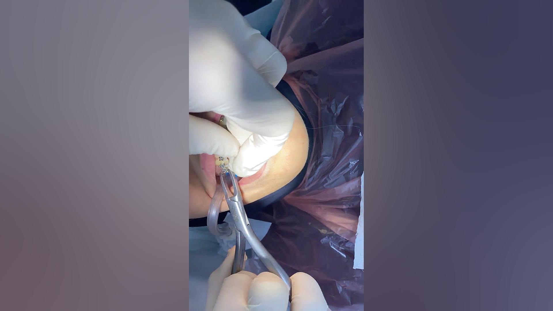 باز کردن ارتودنسی جلسه اخر دکتر مهدی فهیمی هنزائی دكتر مهدي فهيمي هنزائي