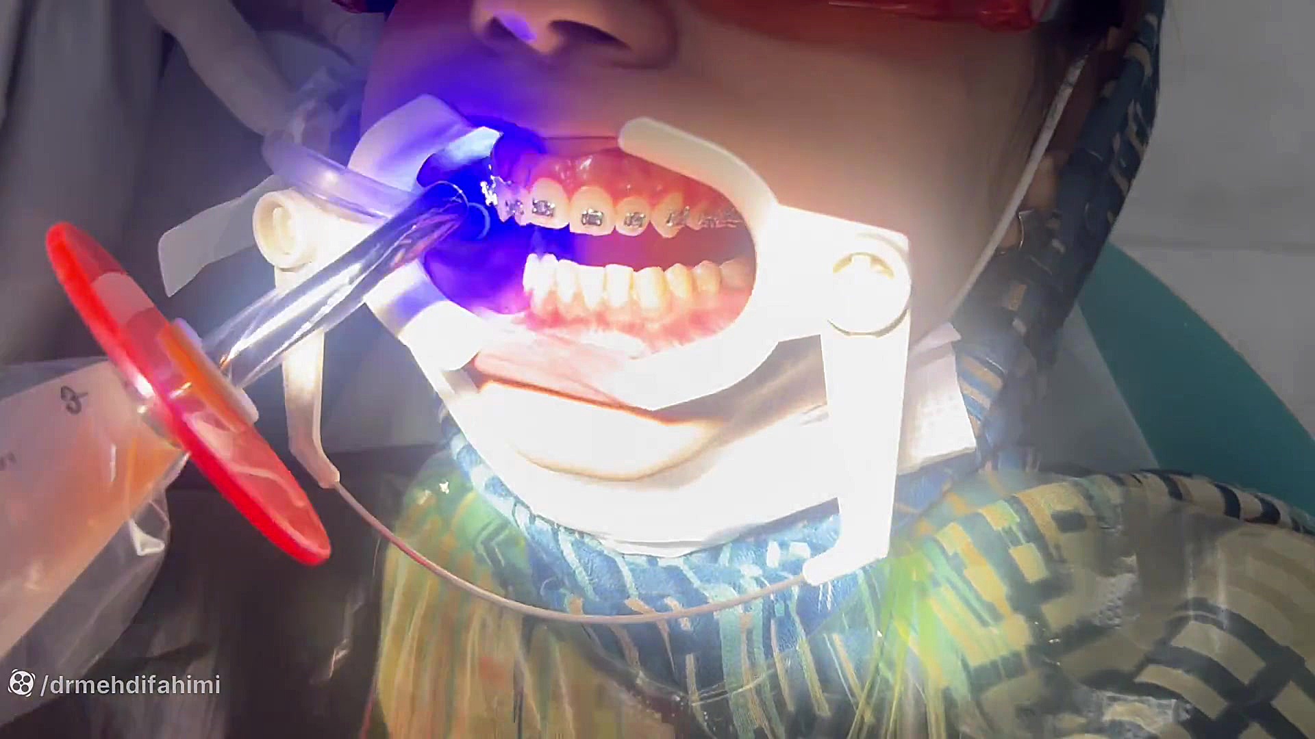 اولین جلسه ارتودنسی ترس نداره دكتر مهدي فهيمي هنزائي