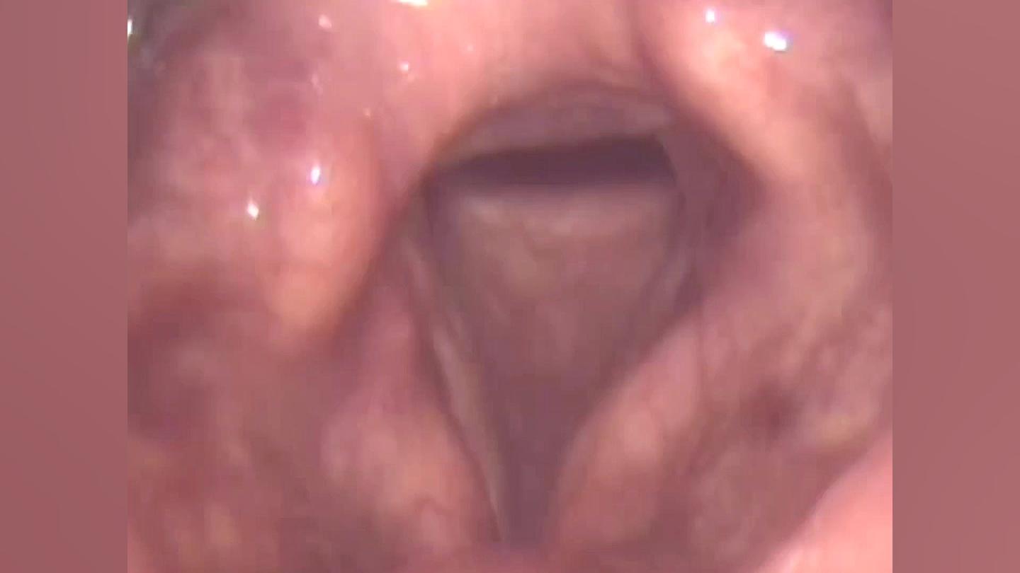 عکسبرداری و تصویربرداری از حنجره پالپوتومی